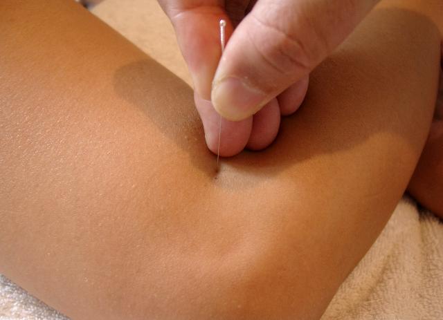 acupuncture